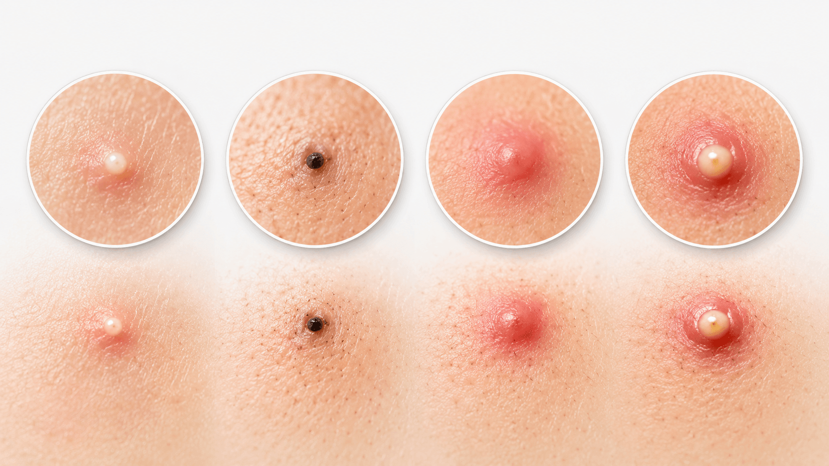 tipos de acne e formação no folículo piloso