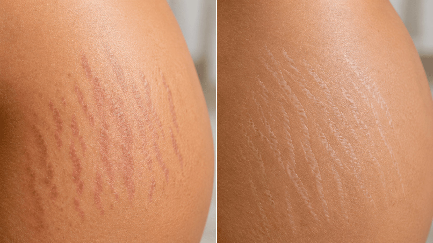 tipos de estrias vermelhas e brancas diferenca